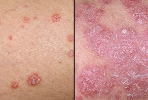 Psoriasis and How to Beat It